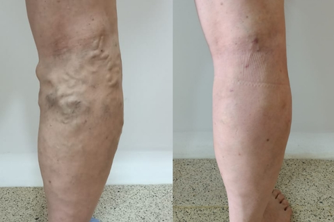 imágenes de antes y después del tratamiento de várices